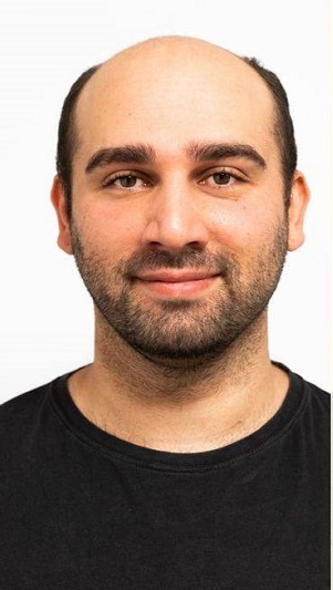 قبل از کاشت موی سر در رشت